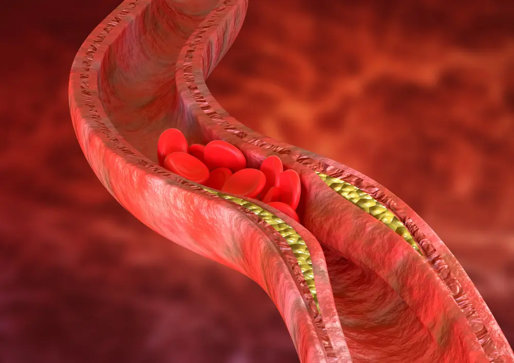 Za wysoki cholesterol blokuje przepływ krwi